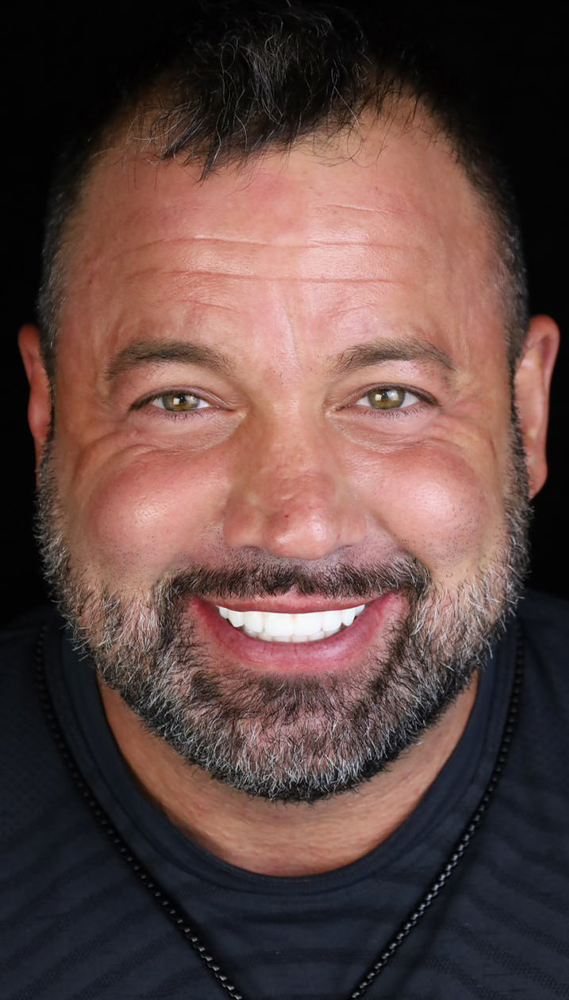 Patient with a full arch implant smiling