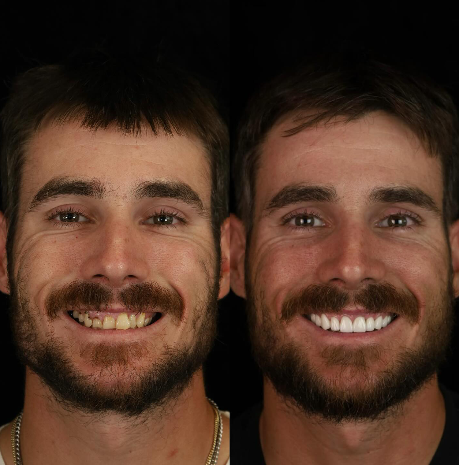 a photo of a patient smiling before dental implant surgery and after dental implant surgery