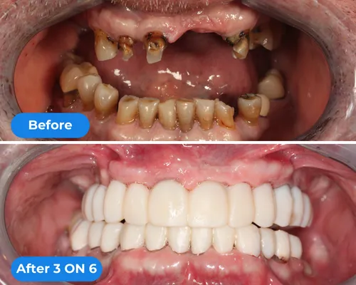 before & after picture of a dental implant restoration