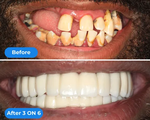 before & after picture of a dental implant restoration