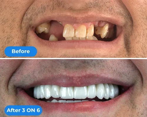 before & after picture of a dental implant restoration